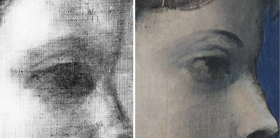 Detail of X-radiograph showing the boy’s eye and detail of the same area showing the girl’s eye